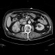 Pyelonephritis, kidney, follow-up: CT - Computed tomography